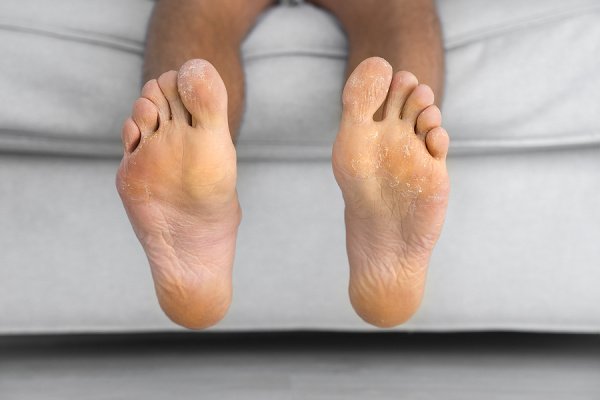 7 Remedies for Athlete’s Foot | Also known as 'tinea pedis', athlete's foot is highly contagious and is pretty uncomfortable. We're sharing everything you need to know, including the signs, symptoms, and causes, prevention tips, and home remedies to teach you how to get rid of athlete's foot once and for all. From hydrogen peroxide and baking soda, to tea tree oil and neem oil, to apple cider vinegar and sea salt, this post explains how to treat athlete's foot naturally!