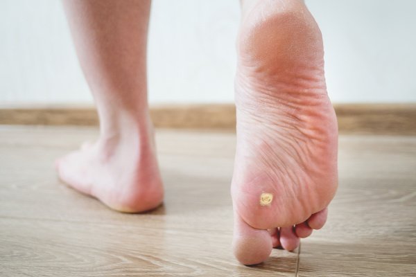 7 Natural Treatments for Plantar Warts | If you want to know how to get rid of plantar warts, this post has everything you need to know. We've outlined common causes and symptoms, prevention tips, and removal ideas and hacks. From the best foot soaks, to duct tape removal hacks, to home remedies that use household ingredients like apple cider vinegar and essential oils like tea tree oil, these DIY wart treatments can be used for adults and for kids!