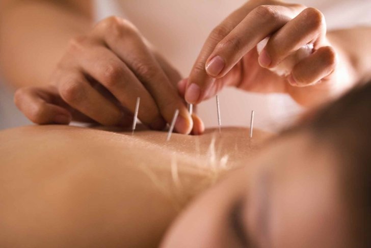 The doctor sticks needles into the girl\'s body on the acupuncture