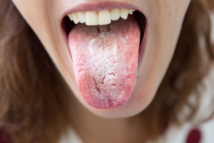 Woman with halitosis for candida albicans on tongue
