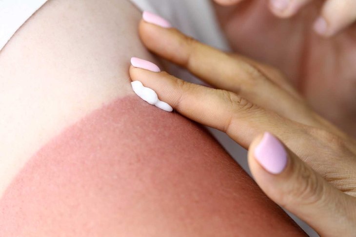 Female hand applies sunburn cream to male hand. Consequences of sunburn concept