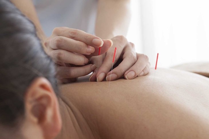 Closeup of woman receiving acupuncture treatment at beauty spa