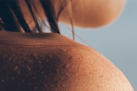 3 Simple Steps to Ease Eczema
